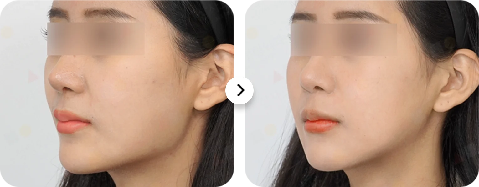 Plastic Surgery before and after showing natural results. 345 Plastic Surgery.