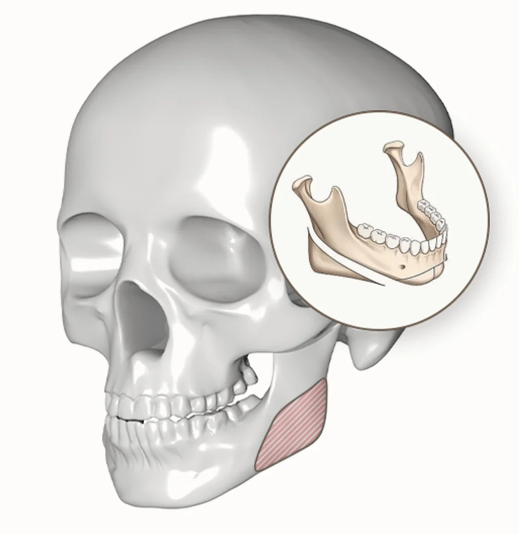 Skull with jaw bone diagram for 345 plastic surgery where natural results.