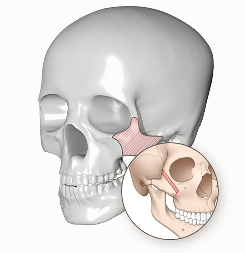 Facial bone structure for 345 plastic surgery where natural. Skull anatomy diagram.