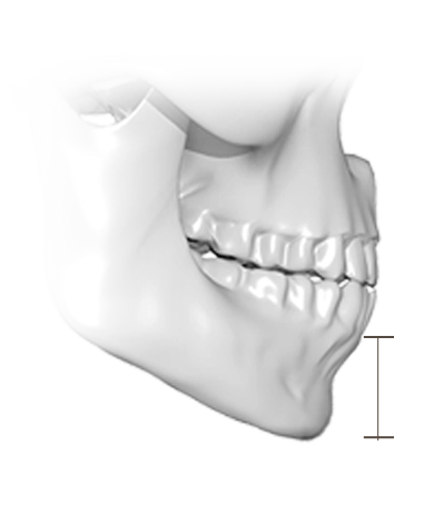 Human skull for 345 plastic surgery where natural, side view.