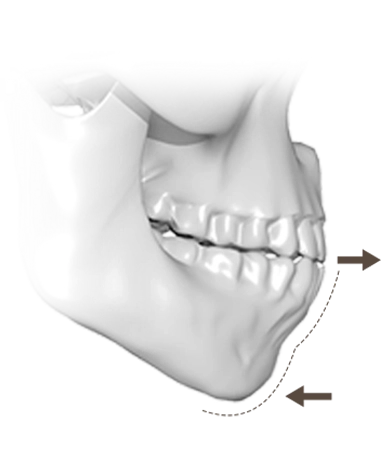 Plastic surgery for natural jawline. Chin augmentation plastic surgery. 345 Plastic Surgery.
