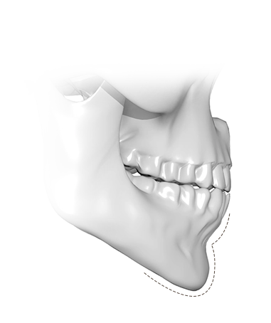 345 Plastic Surgery jawline contouring for natural plastic surgery results