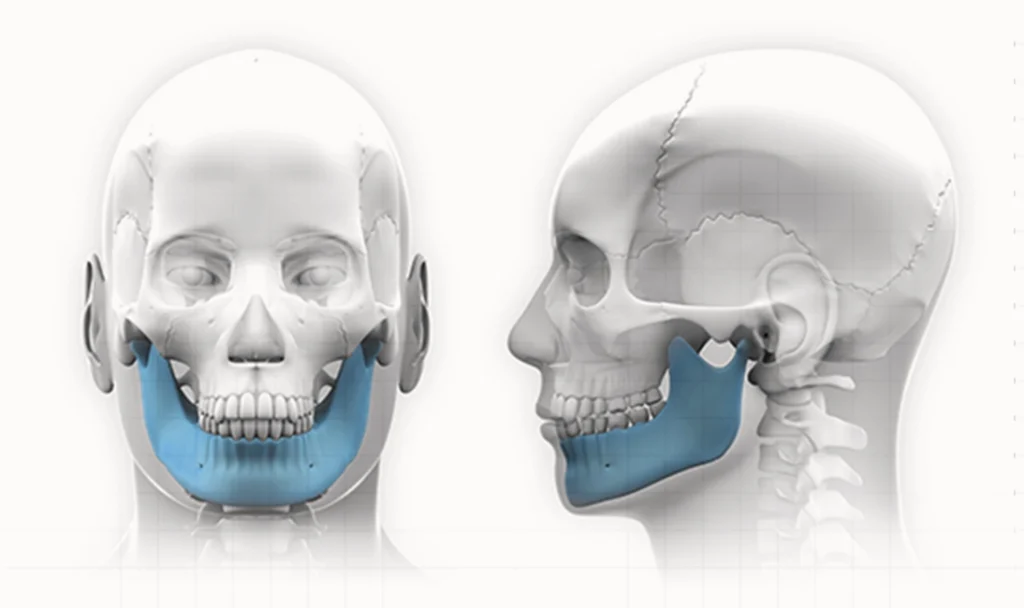 Jawline plastic surgery. Front and side views of the jaw bone. 345 Plastic Surgery where natural.