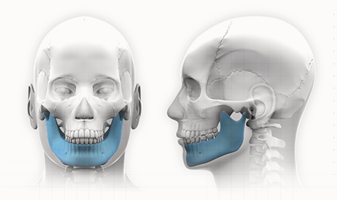 Jawline plastic surgery. Front and side views of the jaw bone. 345 Plastic Surgery where natural.