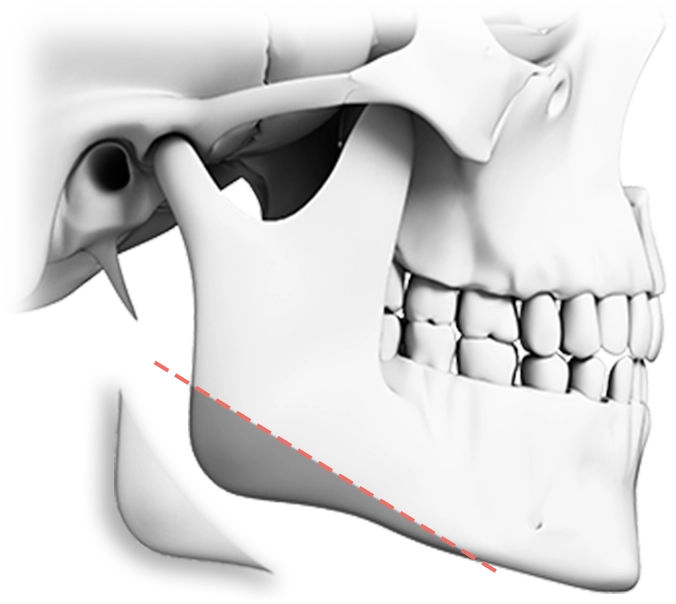 345 Plastic Surgery jawline contouring on a skull for natural results. Plastic surgery where natural.