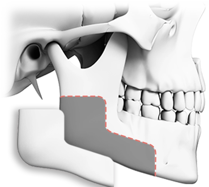 345 Plastic Surgery where natural jaw reduction plastic surgery illustration. Skull shows jawline reshaping.