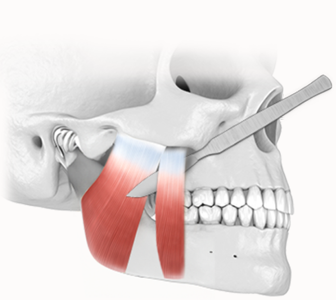 Jaw bone diagram for 345 plastic surgery where natural plastic surgery procedure.