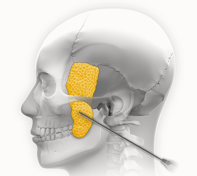 Buccal fat removal plastic surgery diagram for natural 345 face contouring.