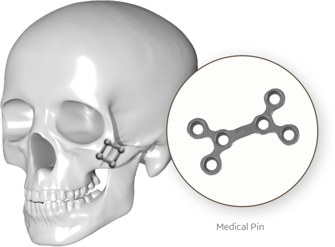 345 Plastic Surgery where natural: Skull with medical pin for plastic surgery.