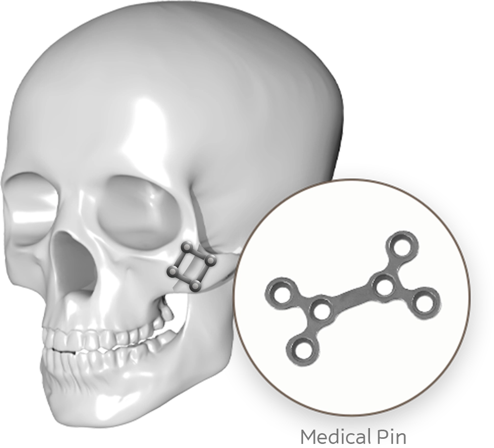 Skull with medical pin for 345 plastic surgery where natural reconstruction.