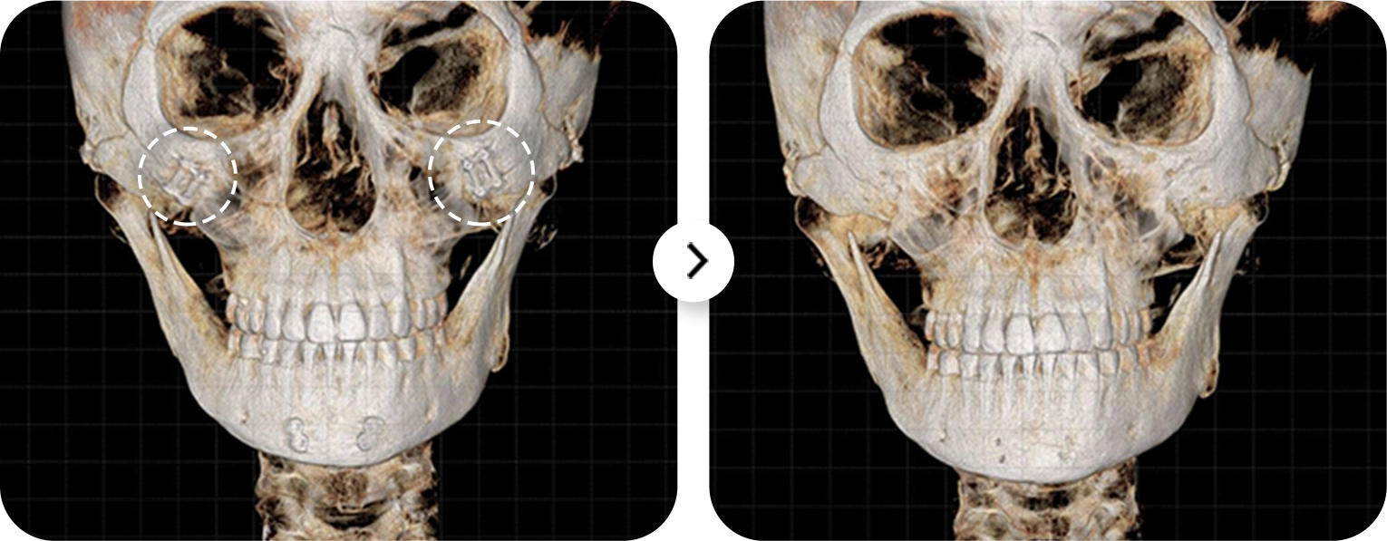345 Plastic Surgery skull CT scan shows natural cheek implants before and after.