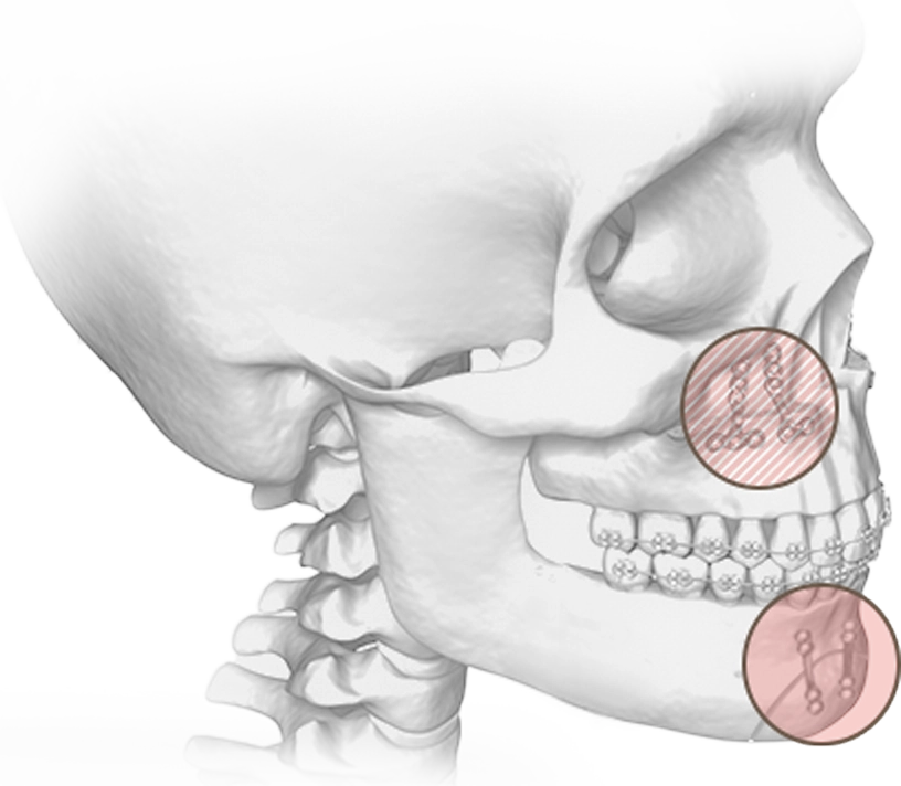 345 Plastic Surgery skull with plates for natural plastic surgery