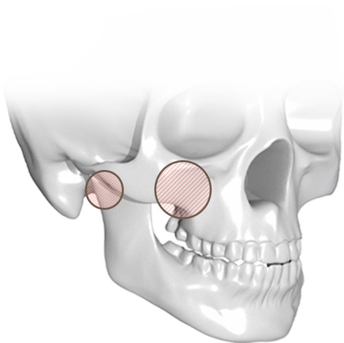 345 Plastic Surgery where natural Skull illustration showing areas for plastic surgery.
