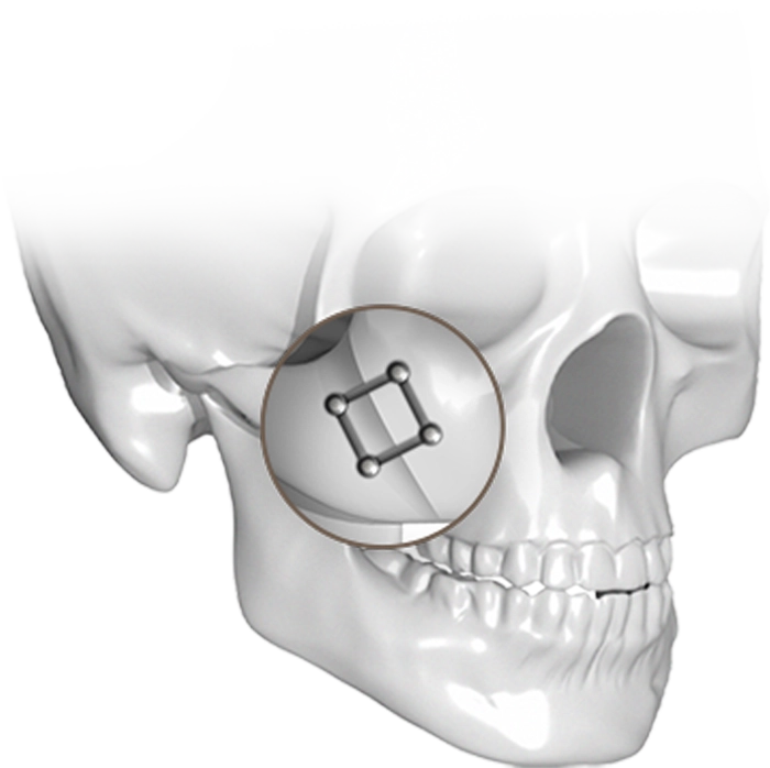 Skull with cheek implant for 345 plastic surgery where natural results are desired.