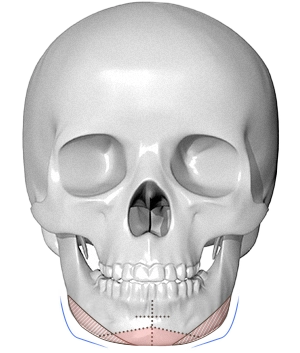 Skull diagram with markings for 345 plastic surgery where natural.