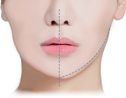 345 Plastic Surgery face with dotted lines showing where natural plastic surgery can be performed