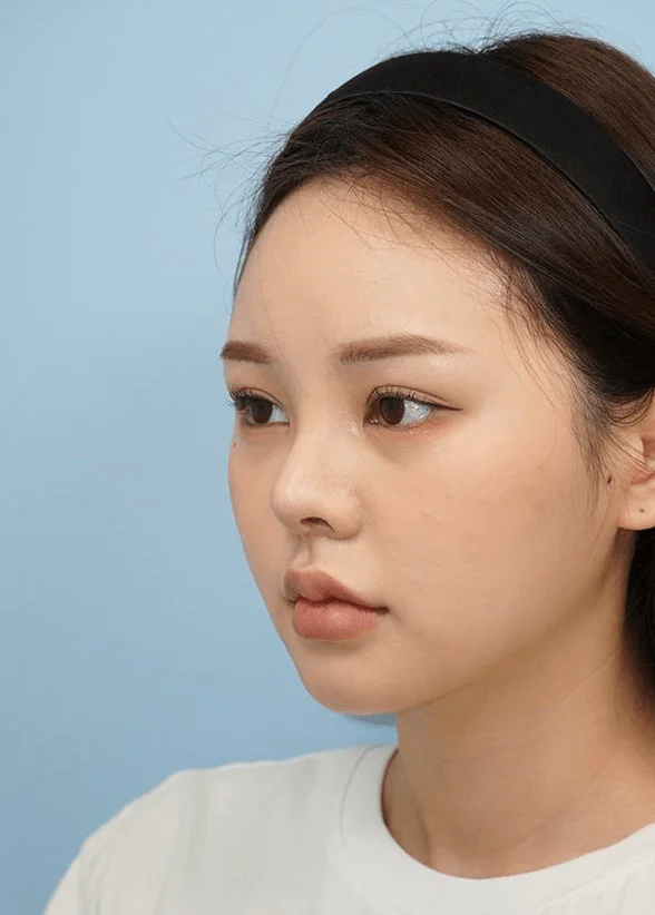 Asian woman with natural look after 345 plastic surgery. Cosmetic procedure results.