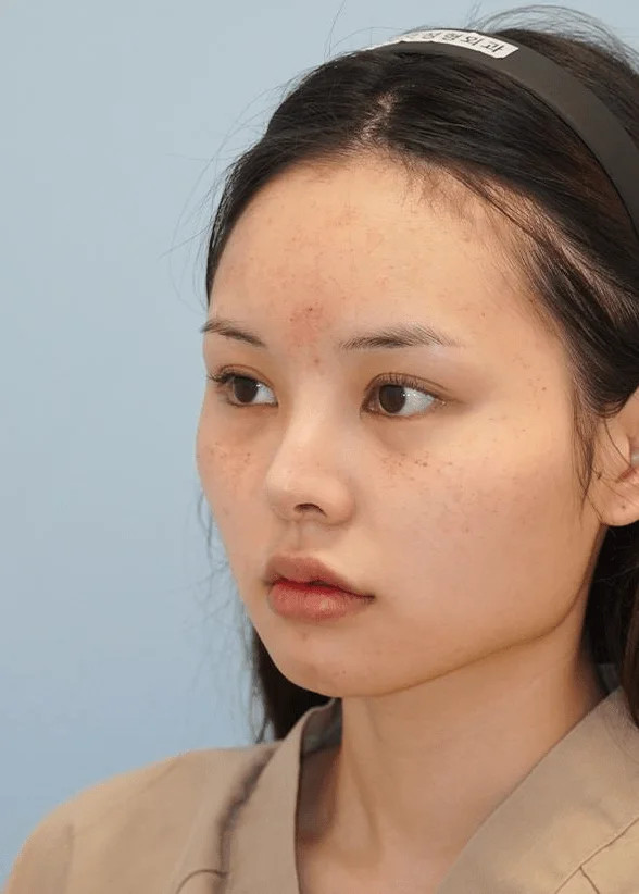 Asian woman with freckles, 345 plastic surgery where natural.