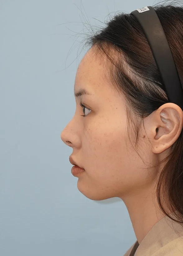 Asian woman profile view for 345 plastic surgery where natural results are achieved.