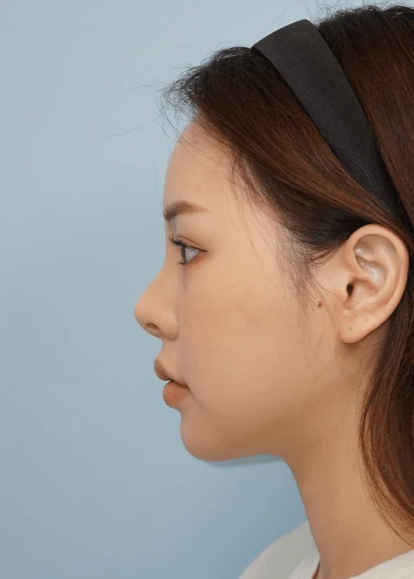 Asian woman profile view for 345 Plastic Surgery where natural results are visible.