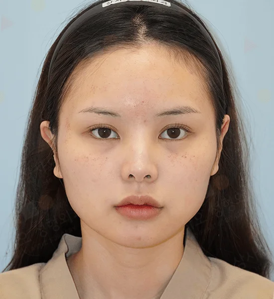 Asian woman before 345 plastic surgery where natural, showcasing natural results.