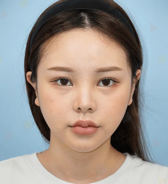 Asian woman face, before 345 plastic surgery procedure, natural look.