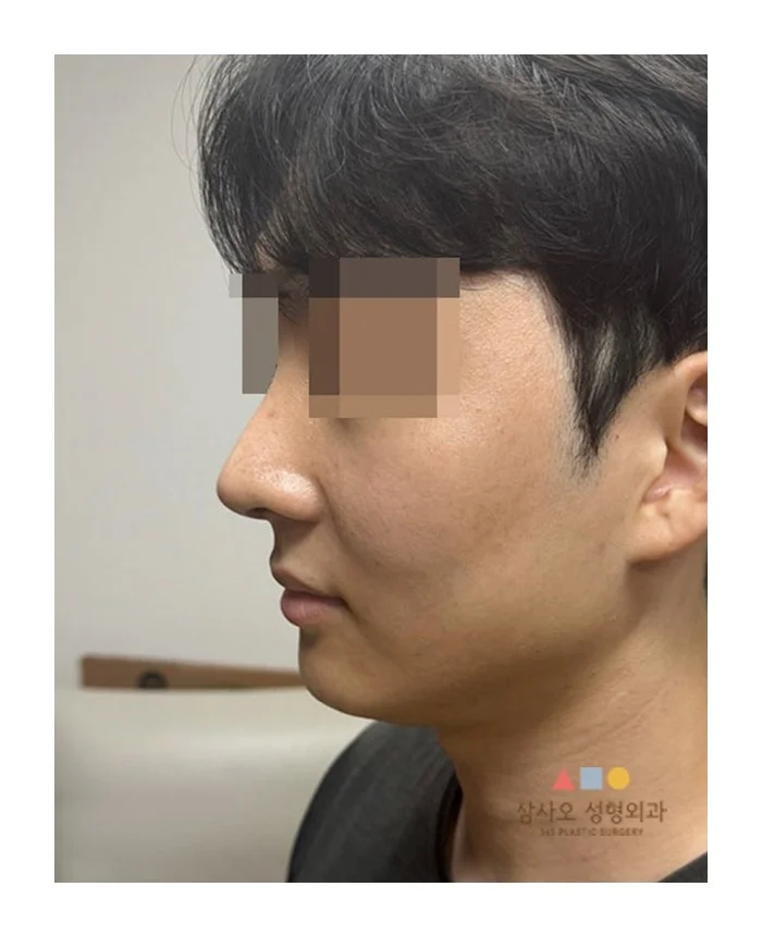 rhinoplasty