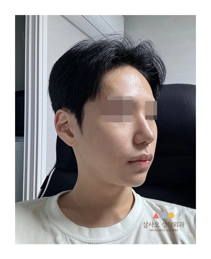rhinoplasty