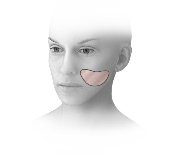 Woman face with highlighted area for 345 plastic surgery where natural cheek augmentation.