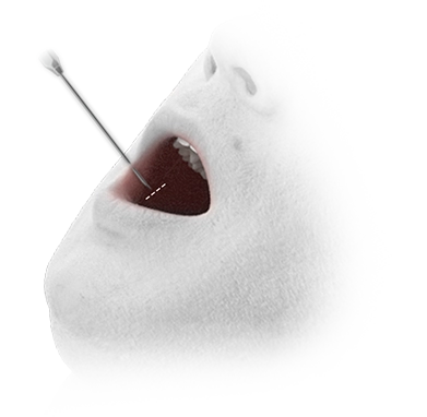 345 Plastic Surgery needle entering mouth for natural plastic surgery procedure