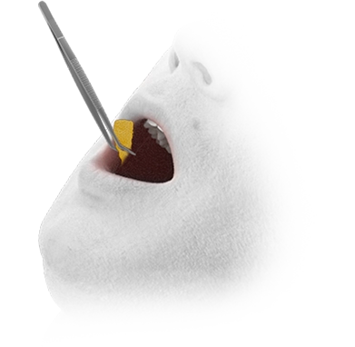 345 Plastic Surgery where natural fat graft in mouth with tweezers. Plastic surgery concept.