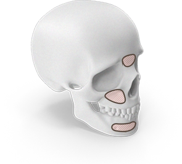 Anatomical skull model showing areas for plastic surgery where natural 345.