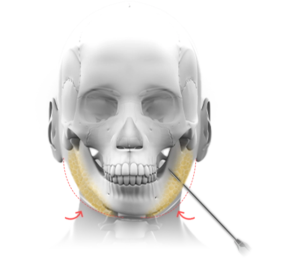 345 Plastic Surgery where natural chin liposuction on skull model. Plastic surgery for natural results.