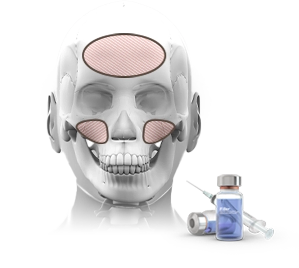 345 Plastic Surgery for natural look. Skull with marked areas for plastic surgery injections.