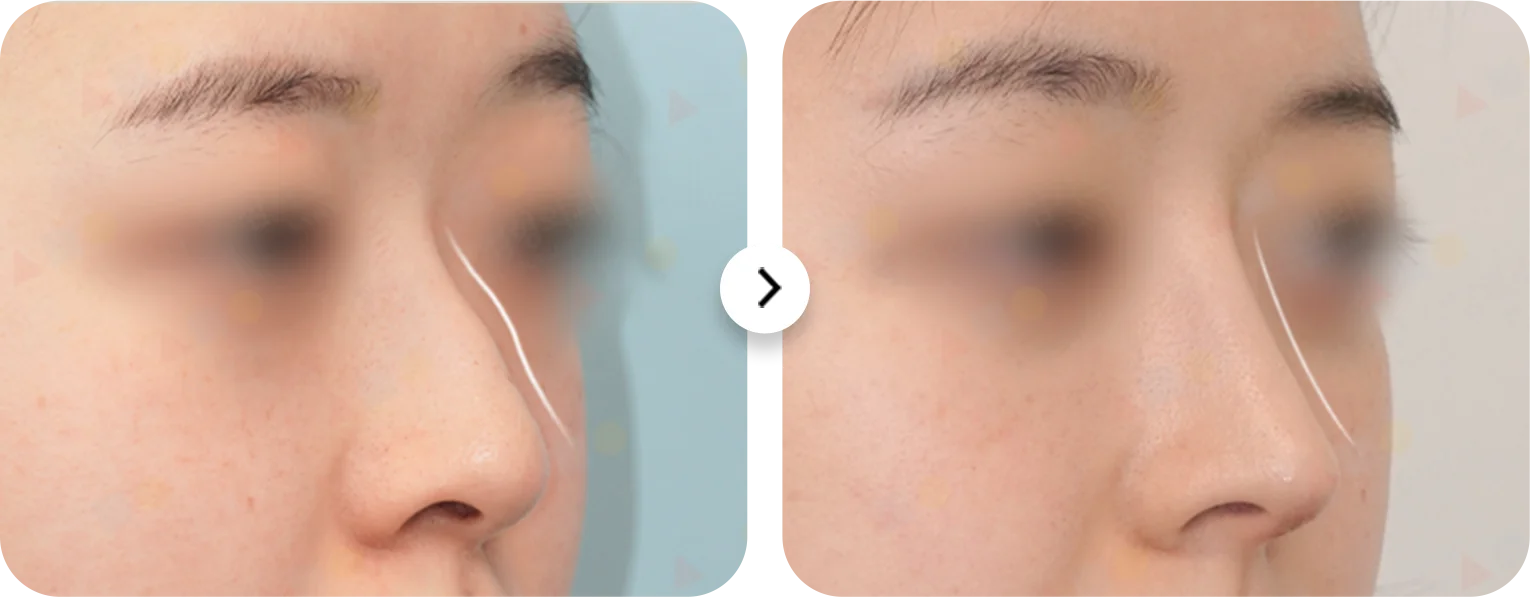Before and after 345 plastic surgery where natural nose job. Rhinoplasty results.