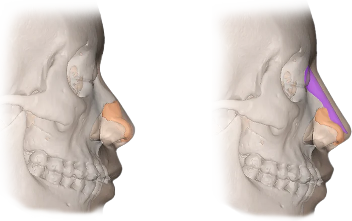 345 Plastic Surgery: Skull showing before and after natural rhinoplasty.