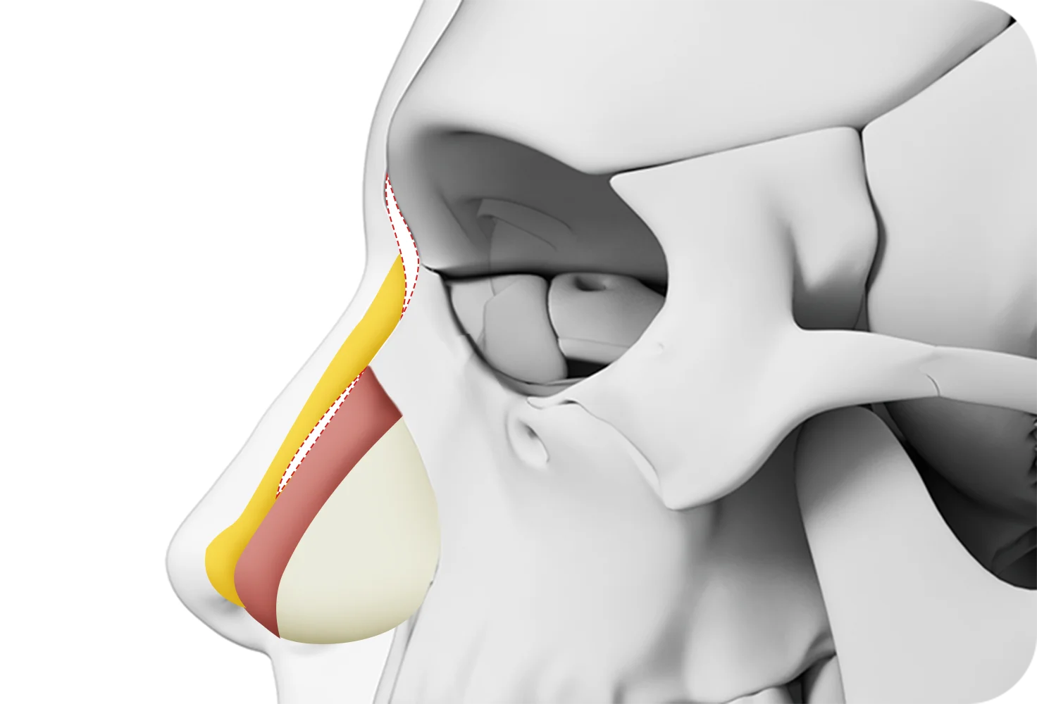 Rhinoplasty diagram showing nasal plastic surgery for natural 345 results.