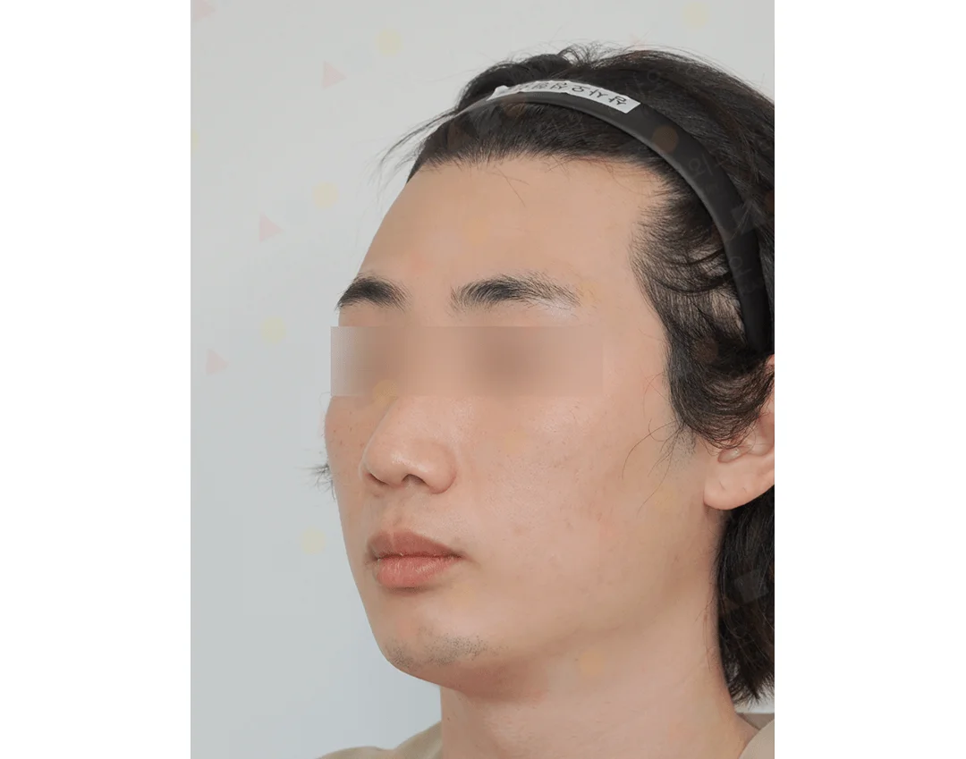 Asian man's face before 345 plastic surgery where natural.