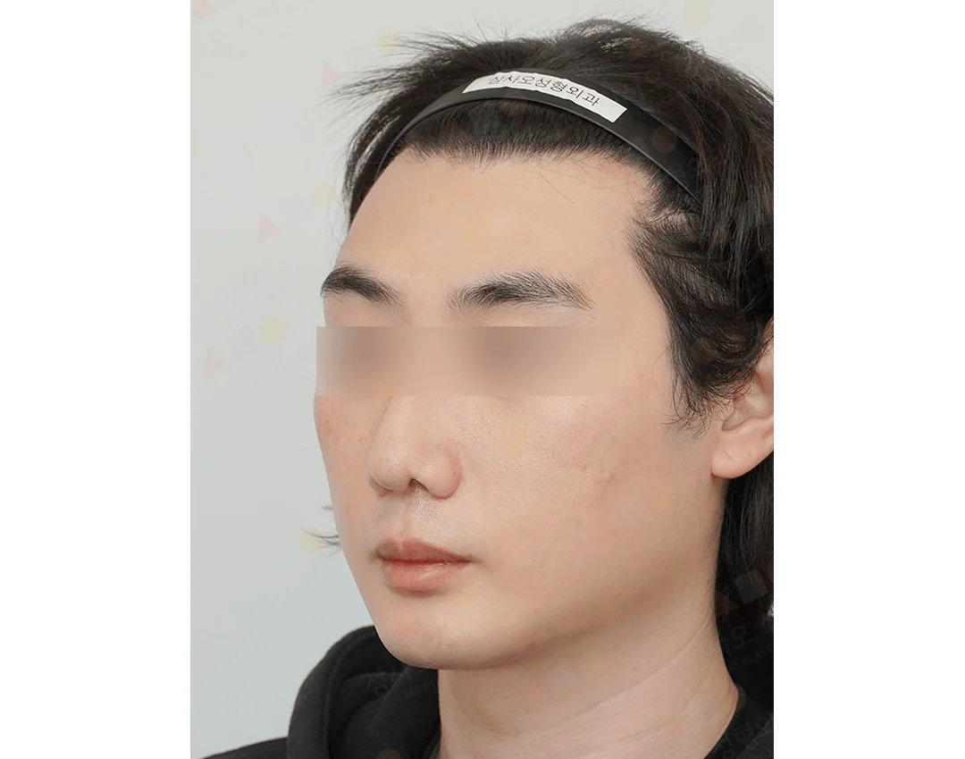 Man with headband before 345 plastic surgery for natural results.