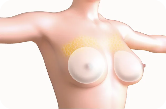 Breast augmentation plastic surgery illustration showing natural results 345. Plastic surgery where natural.