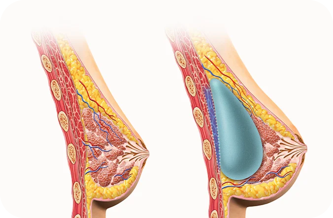 Breast augmentation before and after diagram. 345 plastic surgery for natural results.