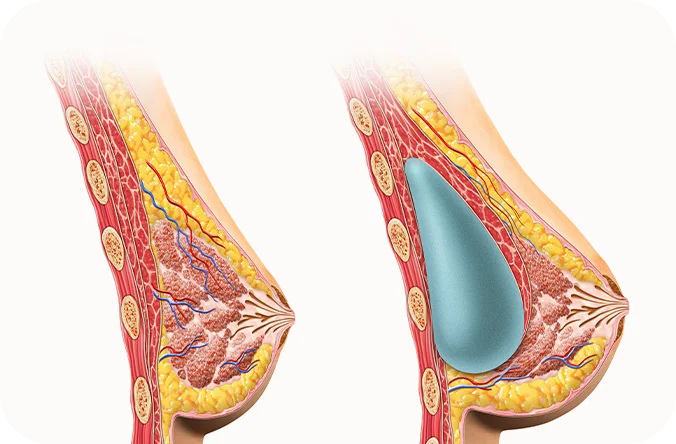 Breast augmentation diagram showing before and after 345 plastic surgery for natural results.