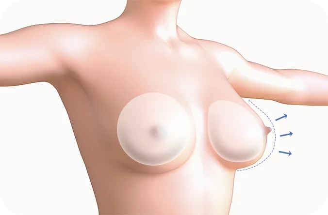 345 Plastic Surgery for natural breast augmentation. Breast lift plastic surgery.
