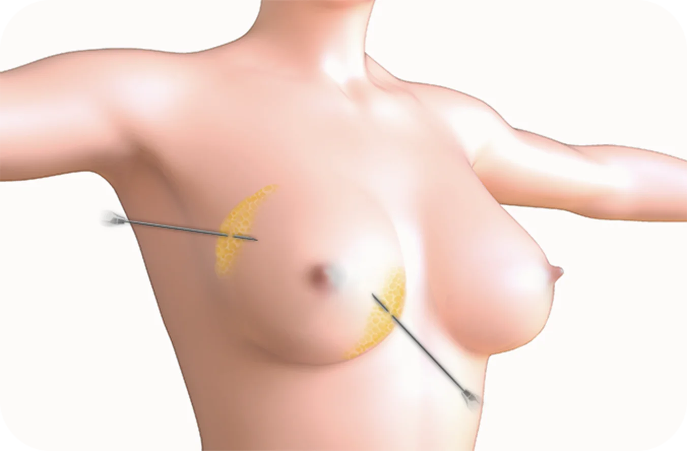 345 Plastic Surgery breast augmentation where natural. Breast implant plastic surgery.