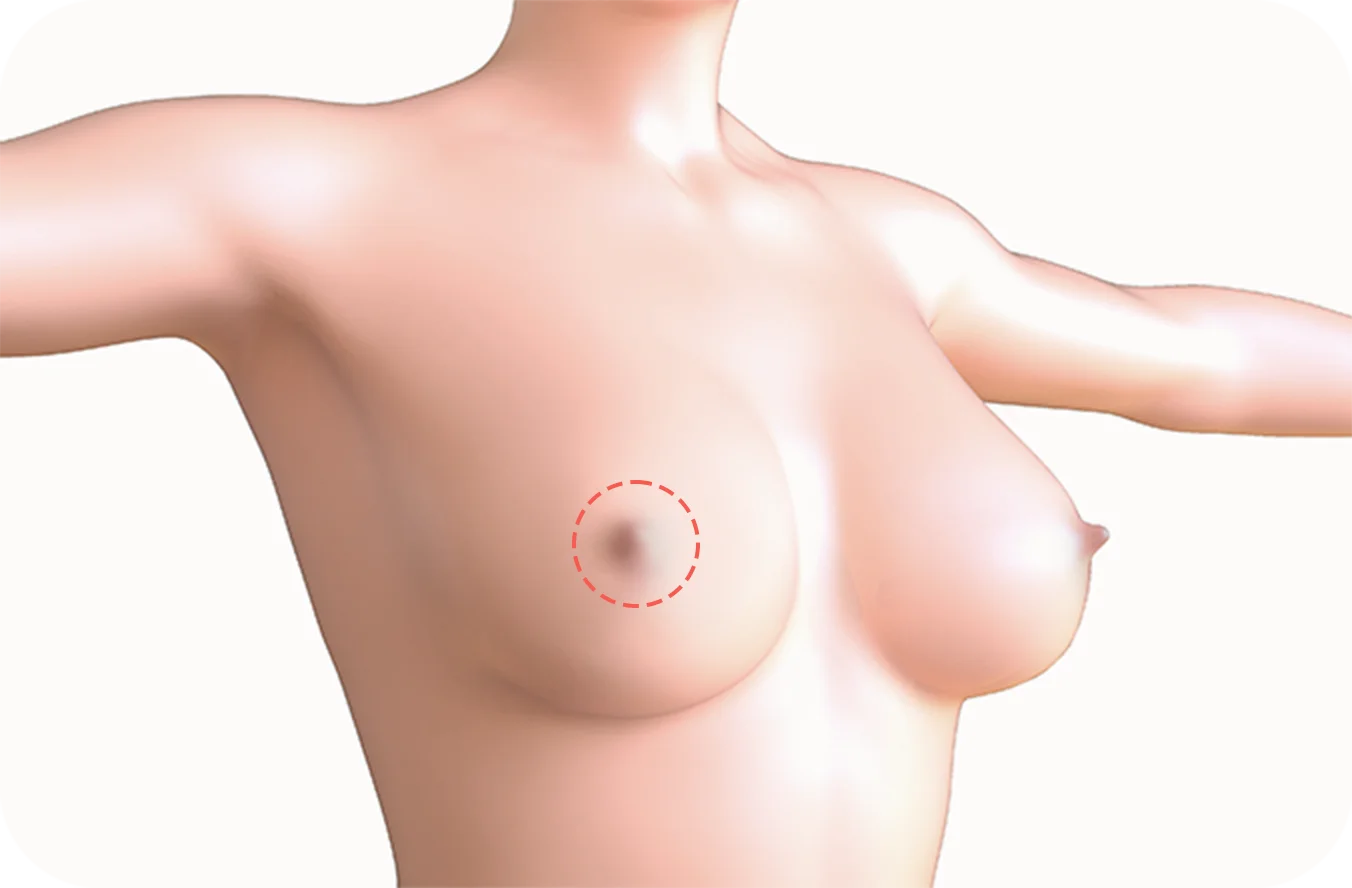 Illustration of breasts showing tubular breast deformity for 345 Plastic Surgery where natural