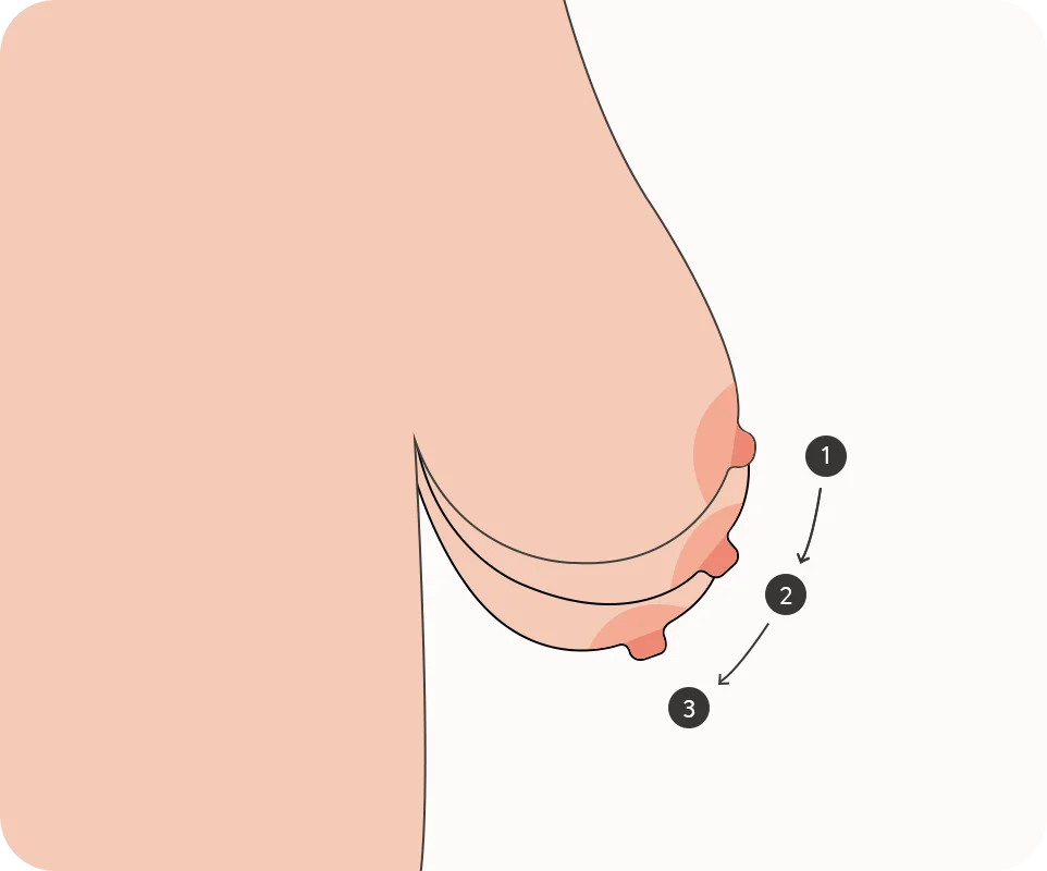 345 Plastic Surgery where natural breast ptosis stages diagram. Natural breast lift plastic surgery.