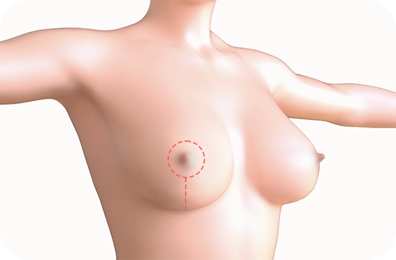 Female chest marked for 345 Plastic Surgery where natural breast augmentation.