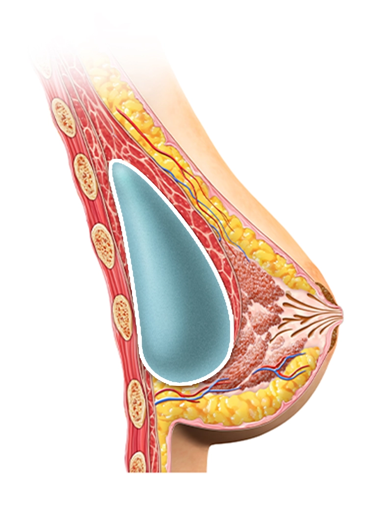 Anatomical illustration of breast implant for 345 Plastic Surgery where natural breast augmentation.