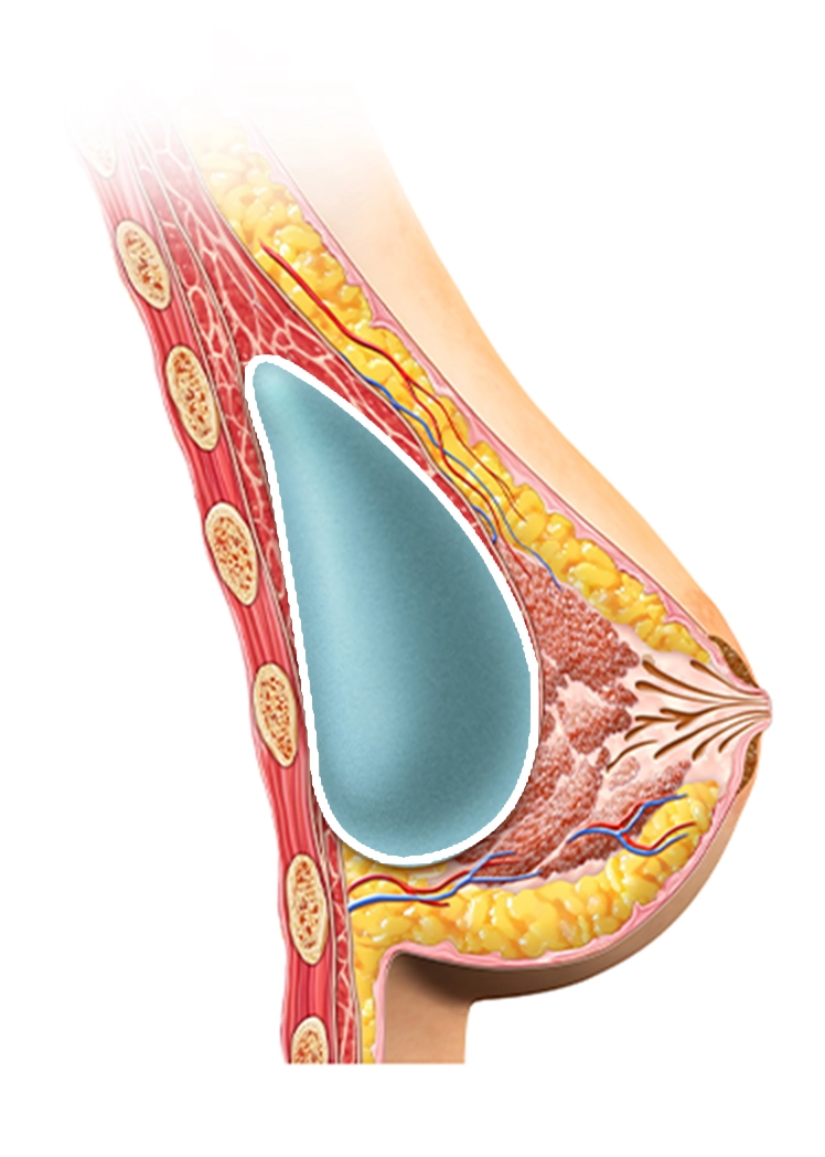 Breast implant diagram for 345 plastic surgery where natural results are the goal.