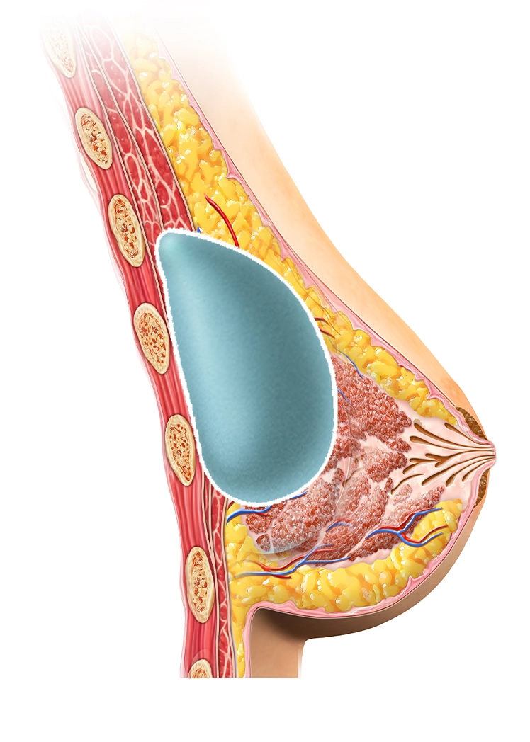 345 Plastic Surgery breast implant diagram showing natural results. Plastic surgery where natural.